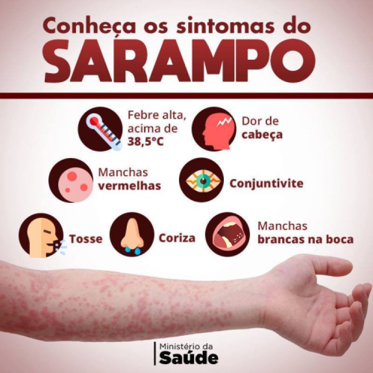 O Brasil enfrentou surto de sarampo em 21 estados no ano passado