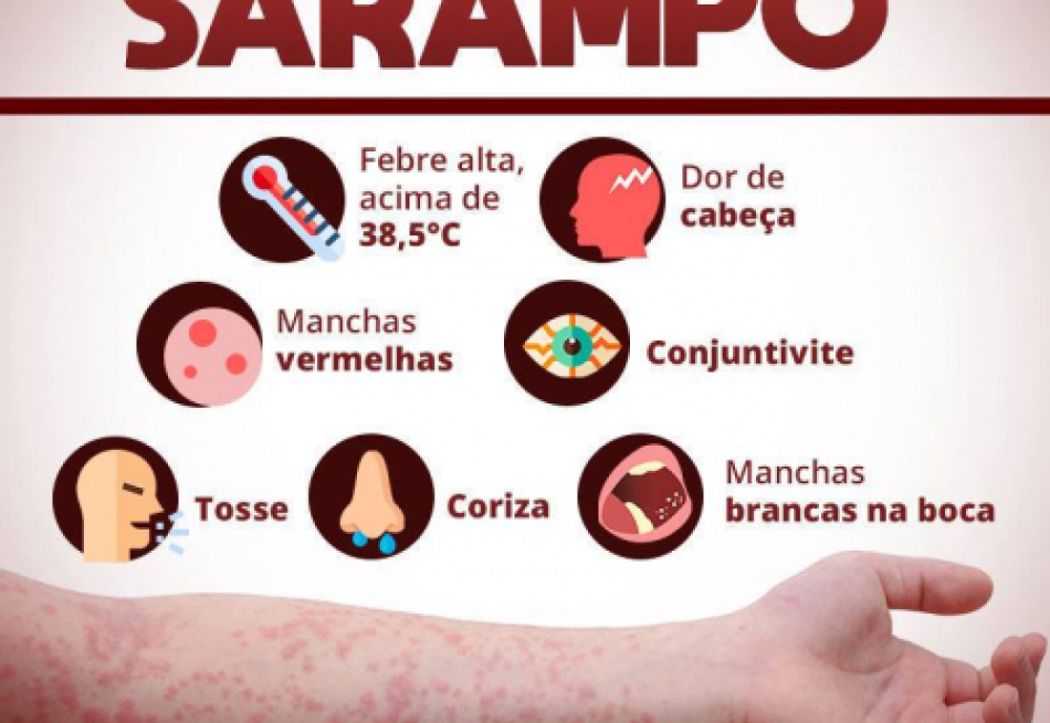 O Brasil enfrentou surto de sarampo em 21 estados no ano passado